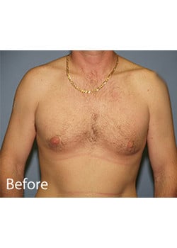 Before Image: Male Breast Reduction - front