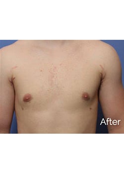 After Image: Male Breast Reduction - front
