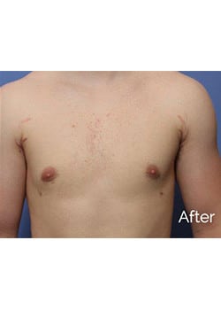 Male Breast Reduction