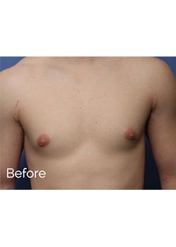 Before Image: Male Breast Reduction - front