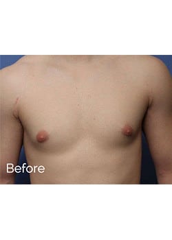 Male Breast Reduction