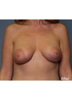 After Image: Mommy Makeover Case 2 - front