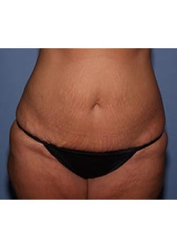 Before Image: Mommy Makeover Case 2 - front