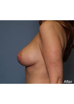 After Image: Mommy Makeover Case 2 - other