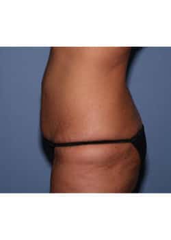 Before Image: Mommy Makeover Case 2 - other