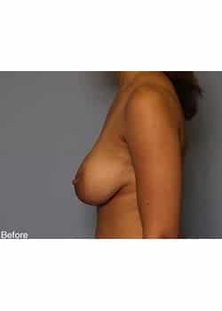 Before Image: Mommy Makeover Case 5 - other