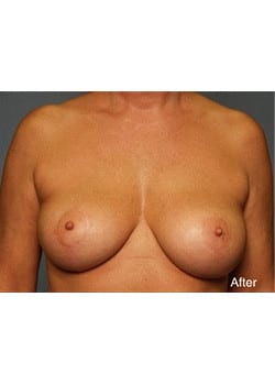 After Image: Mommy Makeover Case 4 - front