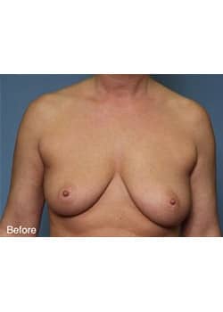 Before Image: Mommy Makeover Case 4 - front