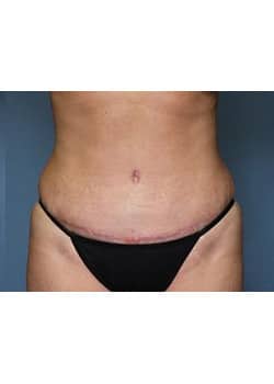 After Image: Mommy Makeover Case 4 - front