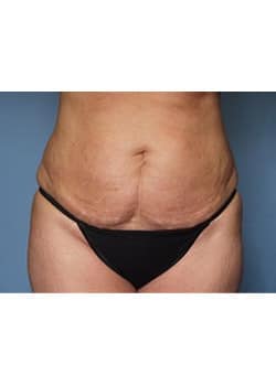 Before Image: Mommy Makeover Case 4 - front