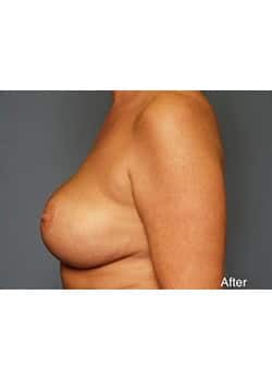 After Image: Mommy Makeover Case 4 - other