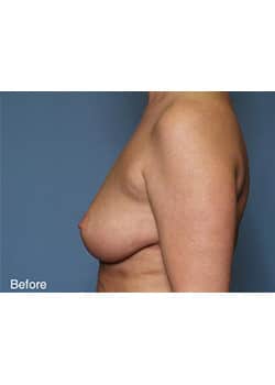 Before Image: Mommy Makeover Case 4 - other