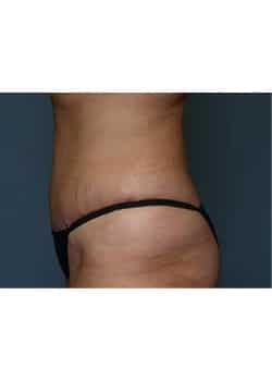 After Image: Mommy Makeover Case 4 - other