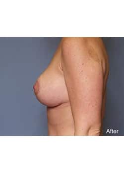 After Image: Mommy Makeover Case 6 - other