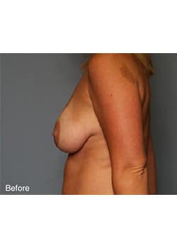 Before Image: Mommy Makeover Case 6 - other