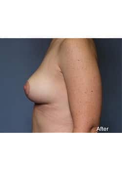 After Image: Mommy Makeover Case 7 - other