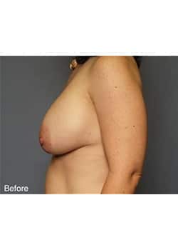 Before Image: Mommy Makeover Case 7 - other