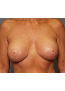 After Image: Mommy Makeover Case 1 - front