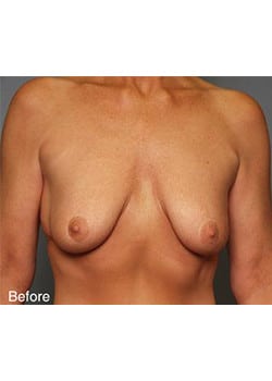 Before Image: Mommy Makeover Case 1 - front