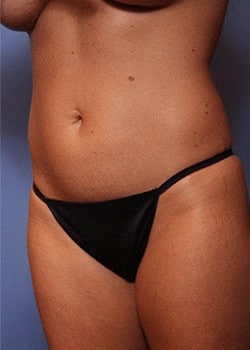 Before Image: HD Vaser - left-front-oblique