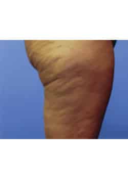 Before Image: CelluSmooth® - other