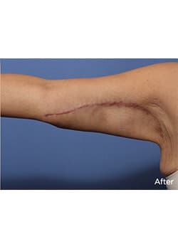 After Image: Brachioplasty - other