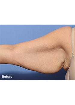 Before Image: Brachioplasty - other