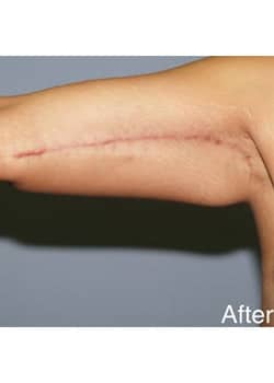 After Image: Brachioplasty - other