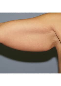 Before Image: Brachioplasty - other