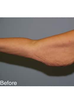 Before Image: Brachioplasty - other