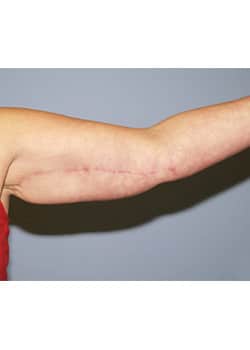 After Image: Brachioplasty - other