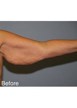 Before Image: Brachioplasty - other