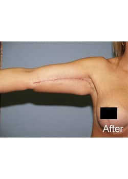 After Image: Brachioplasty - other