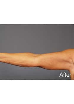 After Image: Brachioplasty - other