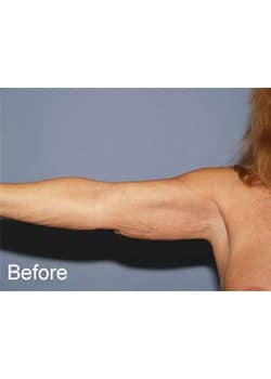 Before Image: Brachioplasty - other