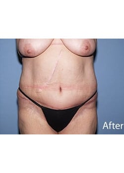 After Image: Body Lift - front