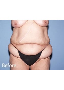 Before Image: Body Lift - front