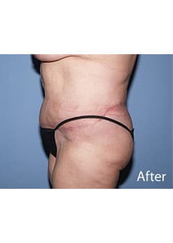 After Image: Body Lift - other