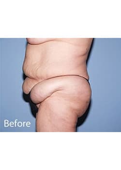 Before Image: Body Lift - other