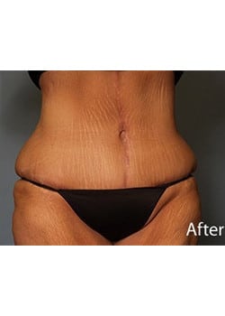 After Image: Body Lift - front