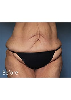 Before Image: Body Lift - front