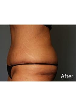After Image: Body Lift - other