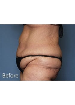 Before Image: Body Lift - other