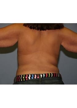 Before Image: Body Lift - back