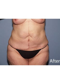 After Image: Body Lift - front