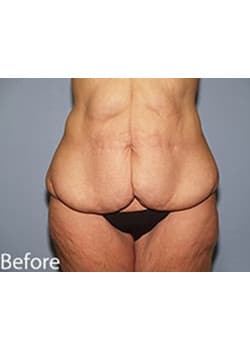 Before Image: Body Lift - front