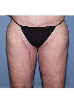 After Image: Body Lift - front