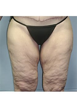 Before Image: Body Lift - front