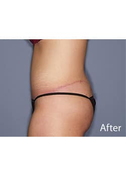 After Image: Body Lift - other