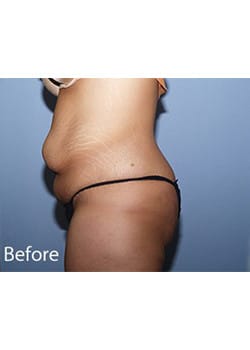 Before Image: Body Lift - other